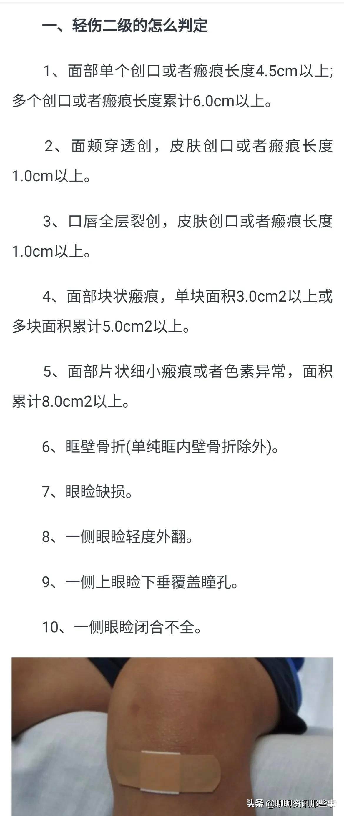 二处轻伤二级会怎么判（殴打他人轻伤的处罚标准） 第1张