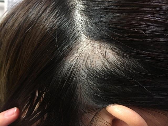 为什么掉头发很厉害怎么办（头发掉的太严重的解决办法） 第7张