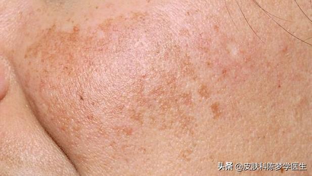 维a酸乳膏害了多少人（到底是神药还是魔药?） 第5张