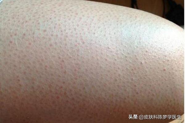 维a酸乳膏害了多少人（到底是神药还是魔药?） 第9张