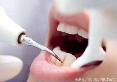 洗牙要多少钱（洗牙一次费用解析） 第3张