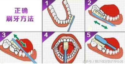 洗牙要多少钱（洗牙一次费用解析） 第5张